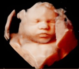 32 week 3D ultrasound